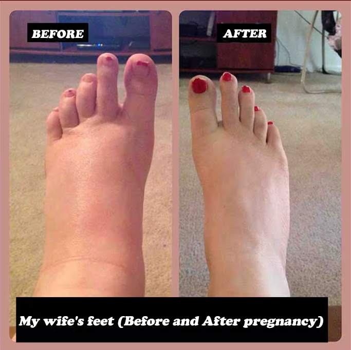 Comprex Ankle Sleeves for pregnancy before and after