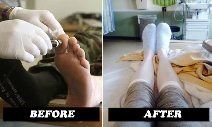 before and after Comprex Ankle Sleeves