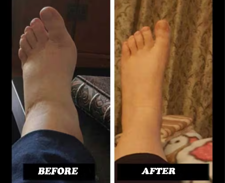 before and after Comprex Ankle Sleeves